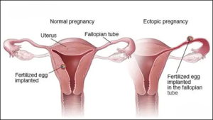 An ectopic pregnancy happens when a fertilized egg sets up shop outside the womb, usually in the fallopian tubes. It's super risky and can't lead to a healthy baby. If you're experiencing severe belly pain, unusual vaginal bleeding, or feel like you might pass out, it's time to dash to the doctor.