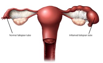 Pelvic Inflammatory Disease (PID) kicks in when infections, usually spread through sex, wander up from the vagina and affect your uterus, fallopian tubes, or ovaries - making pregnancy tougher.